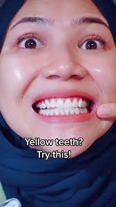 Transform Your Smile with This Convenient Teeth Whitening Kit!