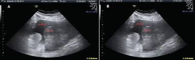 An ultrasound uses sound waves to create a picture of the ovaries, including surrounding tissues, cysts, and tumors. Ascites In Advanced Ovarian Cancer Intechopen