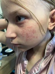 Chemotherapy side effects and skin rash issues in cancer patients