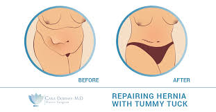 Cassileth, who has had breast augmentation patients who've needed 10 surgeries (and counting) to correct their implants. Tummy Tuck Hernia Repair Dr Cara Downey