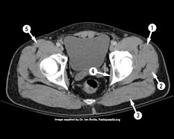 Anatomical drawing of the female pelvis. Ct Pelvis Axial Anatomy Quiz Radiology Case Radiopaedia Org