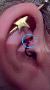 Blood Blister On Daith Daith Piecing 3 Months Old Not Sore I Thought It Had Healed Well However My Husband Noticed Last Night That There Is A Ball Of Blood On The