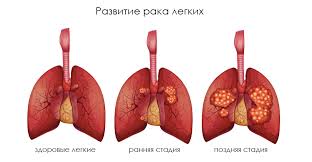 Rak Legkih Novye Protokoly Lecheniya Russkij Doktor