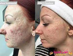 فوائد كريم سكينورين البرتقالي للوجه و التبييض السعر و التجارب orange skinoren cream benefits for face price and exper cream pearl earrings fashion