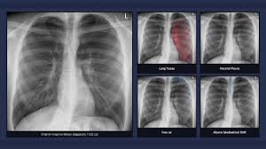 Jul 02, 2021 · a collapsed lung occurs when air escapes from the lung. Simple Pneumothorax Explanation Of Chest X Ray Findings Youtube