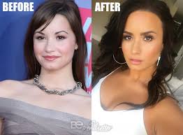 Dancing with the devil on march 22, 2021 in beverly hills, california. Demi Lovato Plastic Surgery Before And After Photos Secrets