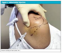 Image result for Subacromial Space Injection