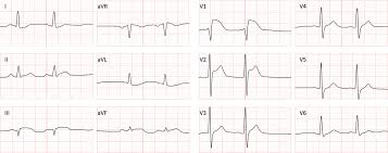 Image result for ST Elevation