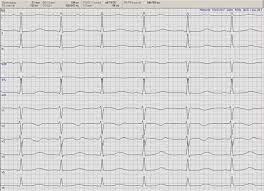 Read on to know more. Medikamentos Induzierte Maligne Arrhythmien Springerlink