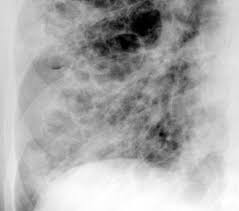 Pulmonary fibrosis — learn about the symptoms, causes and treatment of this serious lung disease that occurs when lung tissue becomes damaged and scarred. Caso Radiologico Adulto