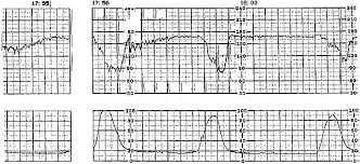 Image result for Early Deceleration