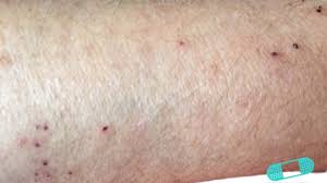 Image result for scabies human bites