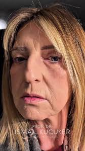 Successful Nose Surgery in London: Deborah's Journey