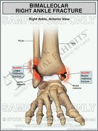 A medial malleolus fracture can include impaction or indenting of the ankle joint. Bimalleolar Right Ankle Fracture Small 8 5 X 11 Digital Presentation Digital File Ankle Fracture Ankle Anatomy Fracture