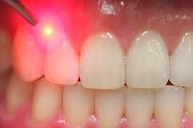 Scientists Have Found Out A Way To Regrow Teeth Using Lasers Https Technnerd Com Scientists Have Found O Gum Disease Treatment Dental Laser Laser Dentistry