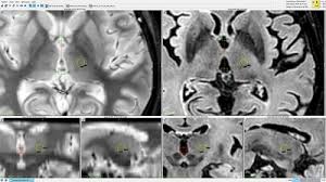 Image result for Thalamotomy