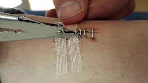 Klammern Entfernen Staple Removal Youtube