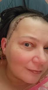 Hey girls! Hope you're all doing great 💕 I'm getting a brow lift and upper  bleph soon, and I just wanted to ask if anyone had any issues with nerve  sensitivity afterwards?