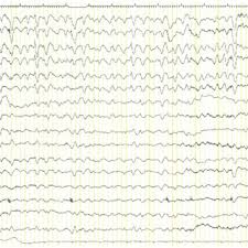 Ictal Electroencephalogram Eeg In A Patient With Nonconvulsive Status Download Scientific Diagram