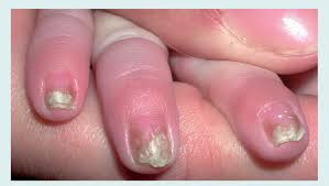 Image result for onychomycosis