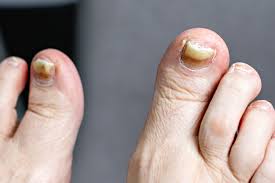 Image result for Pitting nails feet