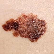 These melanoma pictures could help you spot a cancerous mole. Spot The Differences Between A Mole And Skin Cancer