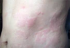This is known as a trigger. Hives Boston Allergic Skin Welts Urticarial Ma