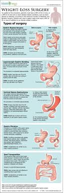 gastric byp surgery weight loss