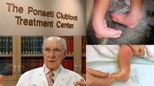 Ponseti developed this technique in the early 1950's at the university of iowa and the ponseti method for clubfoot correction is recognized as the gold standard around the world. International Rotary Fellowship Of Healthcare Professionals The Clubfoot Revolution