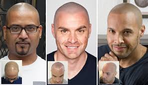 View pictures, photos, and images of before and after pictures of the hair or scalp micropigmentation process conducted by hair train in denver, co. Scalp Micropigmentation Frequently Asked Questions Skalp