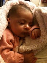 Deleterious Facial Effects Caused by Noninvasive Ventilation Mask Early  Treatment, in Congenital Muscular Dystrophy