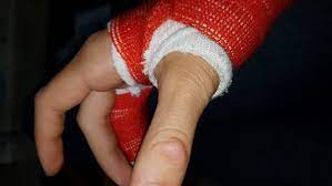 Gips Druckt Krankenhaus Oder Nicht Schmerzen