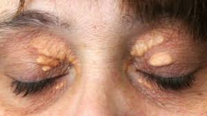 Image result for xantelasma