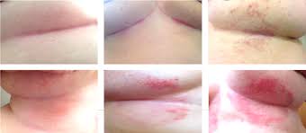 Image result for heat rash under breasts