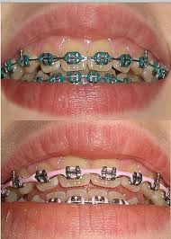 Black And White Braces Color Examples Of Braces Color Combinations Braces Colors Braces Colors Combinations Braces Teeth Colors
