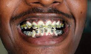 While on braces, you will need frequent dental appointments and most times, the orthodontists at the government hospitals are too please how can i get braces for free and started paying little by little. How Much Does Dental Braces Cost In South Africa Find Out Here Fakaza News