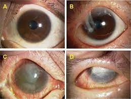 Diagnosis And Treatment Of Stevens Johnson Syndrome And Toxic Epidermal Necrolysis With Ocular Complications Ophthalmology