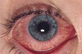 Image result for Ciliary Flush