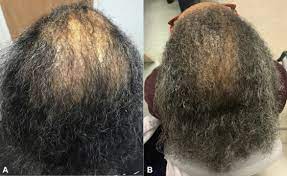 Hair Regrowth In 2 Patients With Recalcitrant Central Centrifugal Cicatricial Alopecia After Use Of Topical Metformin Jaad Case Reports