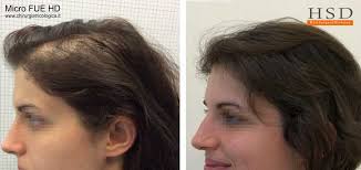 Trapianto di capelli senza rasatura. Trapianto Capelli Donna Tecnica Risultato Calvizie Fasi Hsd
