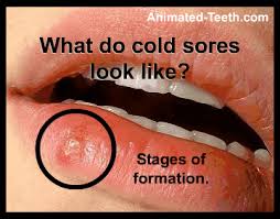 Early symptoms of a cold sore include itching and tingling on or around your lips, before a blister appears, and red or swollen cold sores are common and affect people of all ages. Cold Sore Fever Blister Stages Pictures Signs Symptoms Are They Contagious