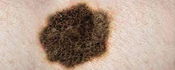 Often starts off with a rough, scaly patch, but can quickly get quite raised, firm, red and crusty. Looking For Skin Cancer Identifying Suspicious Moles Information Myvmc