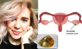 We did not find results for: Calle Hack Finds Cyst With Hair And Teeth Was Caused Her Period Pain Daily Mail Online