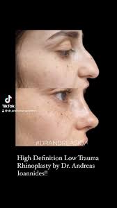 Ρινοπλαστική