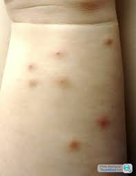 Image result for mite bites on humans