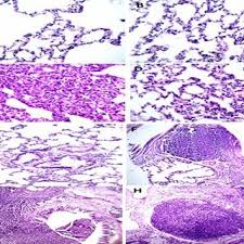 Image result for Pulmonary Intoxicant