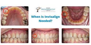 Data on file at align technology as of october 12, 2017. How Long Does Invisalign Take To Straighten Your Teeth Miami Orthodontist Group