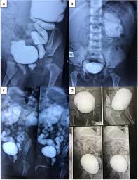 Image result for Voiding Cystourethrogram
