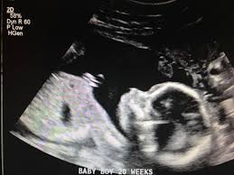 See what your baby looks like now you're three months pregnant with our fetal development images, plus ultrasound pics that show how your baby is developing. Hair In Ultrasound Pic Glow Community