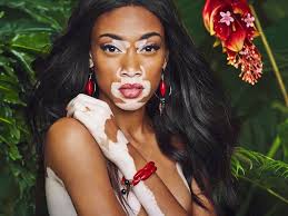 What Has Chantelle Winnie Been Up To Since Antm Ended Vitiligo Treatment Vitiligo Winnie Harlow
